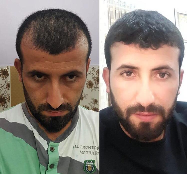 השתלת שיער לגברים