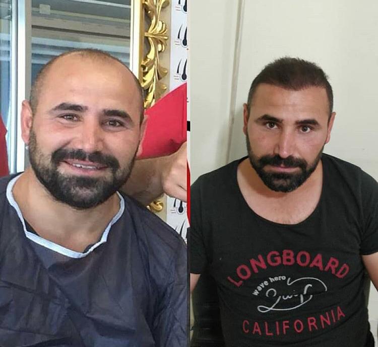 Men Hair Transplantation