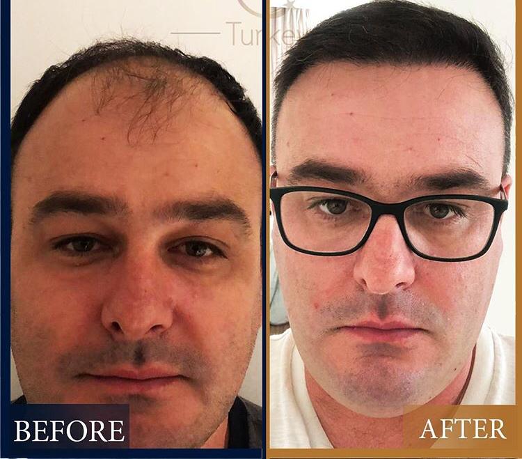 Men Hair Transplantation