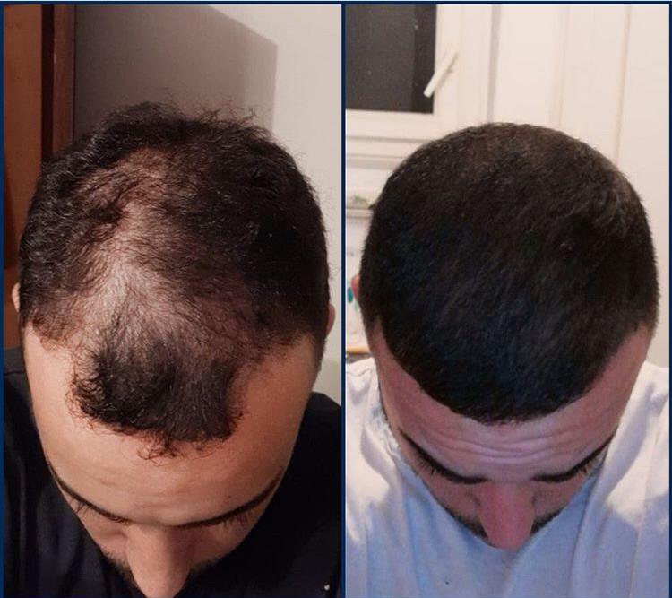Men Hair Transplantation