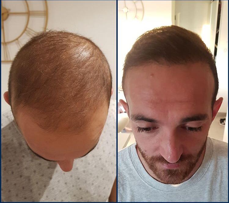 השתלת שיער לגברים