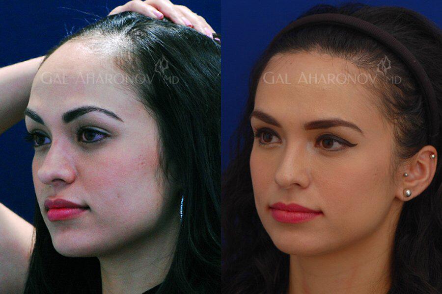Women Hair Transplantation