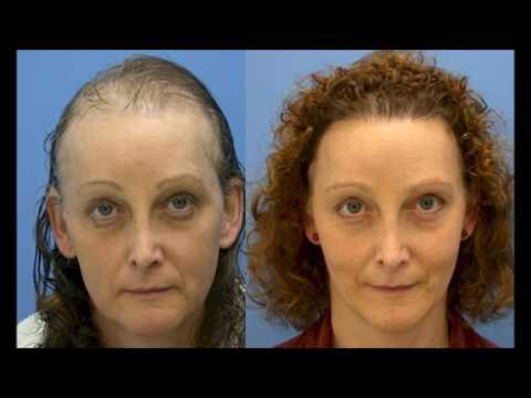 Women Hair Transplantation
