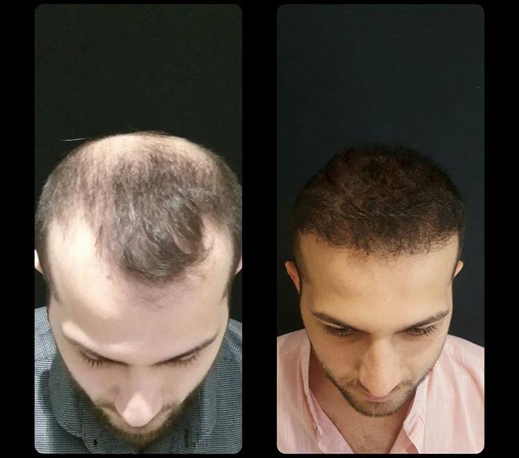 השתלת שיער לגברים