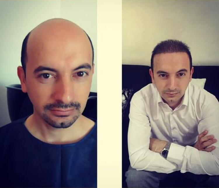 השתלת שיער לגברים