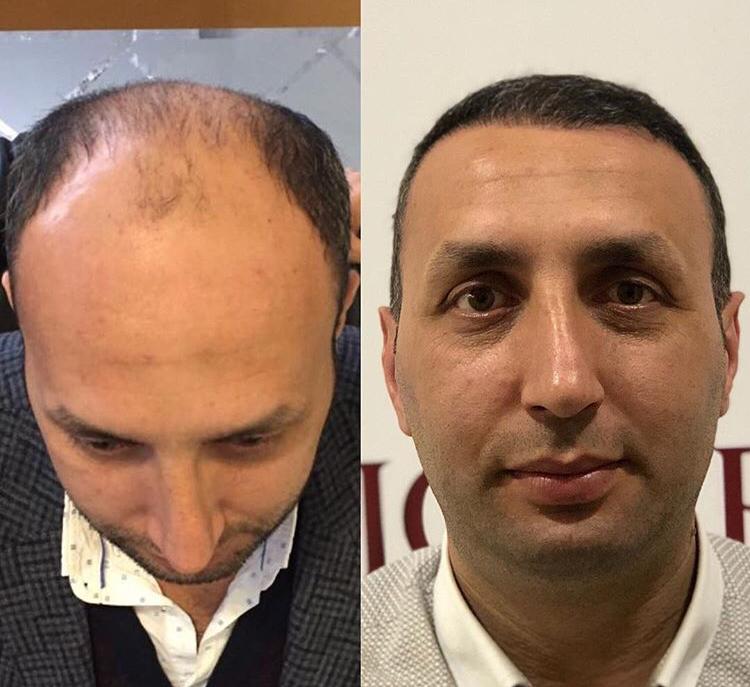 השתלת שיער לגברים