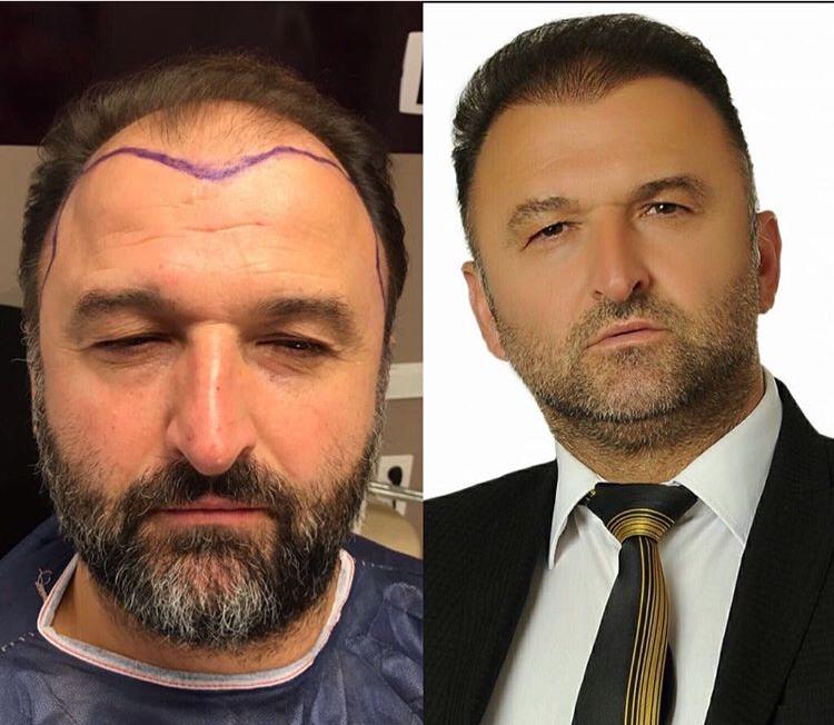 השתלת שיער לגברים