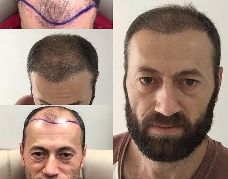 השתלת שיער לגברים
